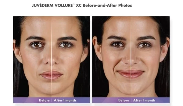 Juvederm vollure xc before after photos