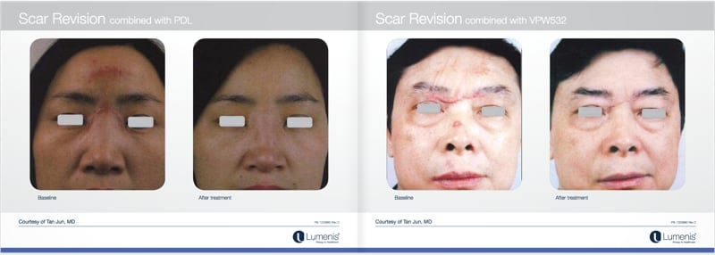 Scar-removal-san-diego-before-and-after-photos-1.jpg