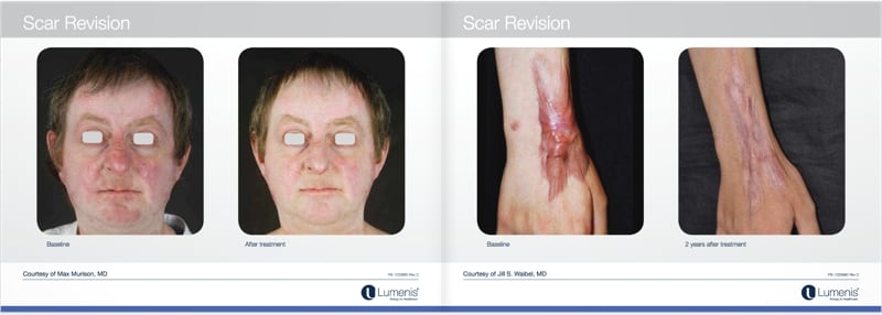 Scar-removal-san-diego-before-and-after-photos-4.jpg