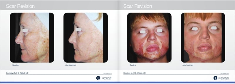 Scar-removal-san-diego-before-and-after-photos-2.jpg