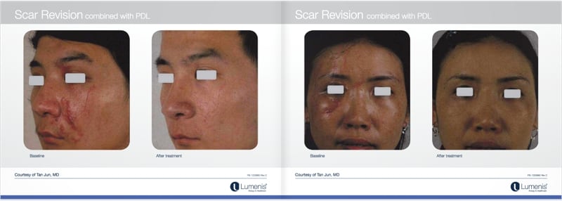 Scar-removal-san-diego-before-and-after-photos-3.jpg