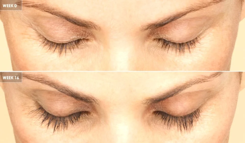 Latisse Is Best Treatment for Thinning Eyelashes