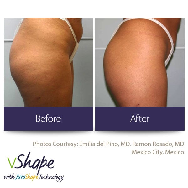 Body Contouring Procedures San Diego, Medical Spa