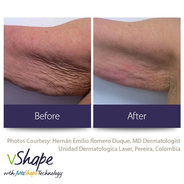 Juvashape-before-and-after-cellulite-san-diego-siti-med-spa.jpg