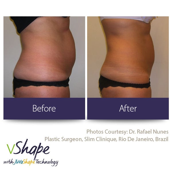 Body Contouring Procedures San Diego, Medical Spa