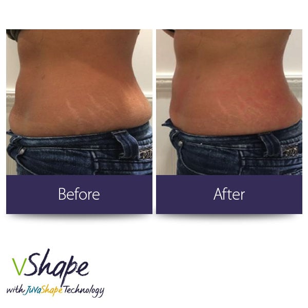 Juvashape-before-and-after-cellulite-2-san-diego-siti-med-spa.jpg