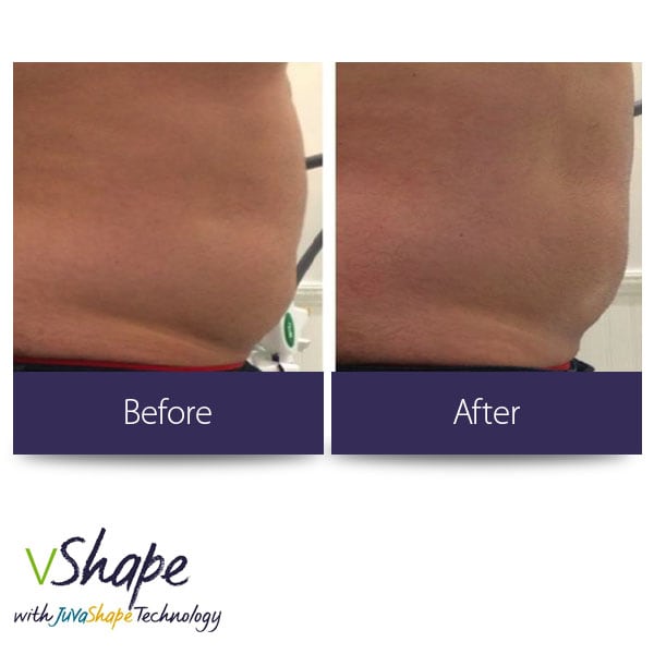 Juvashape-before-and-after-stomach-male-san-diego-siti-med-spa.jpg