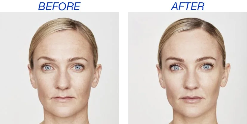 Restylane Before And After Siti Med Spa San Diego