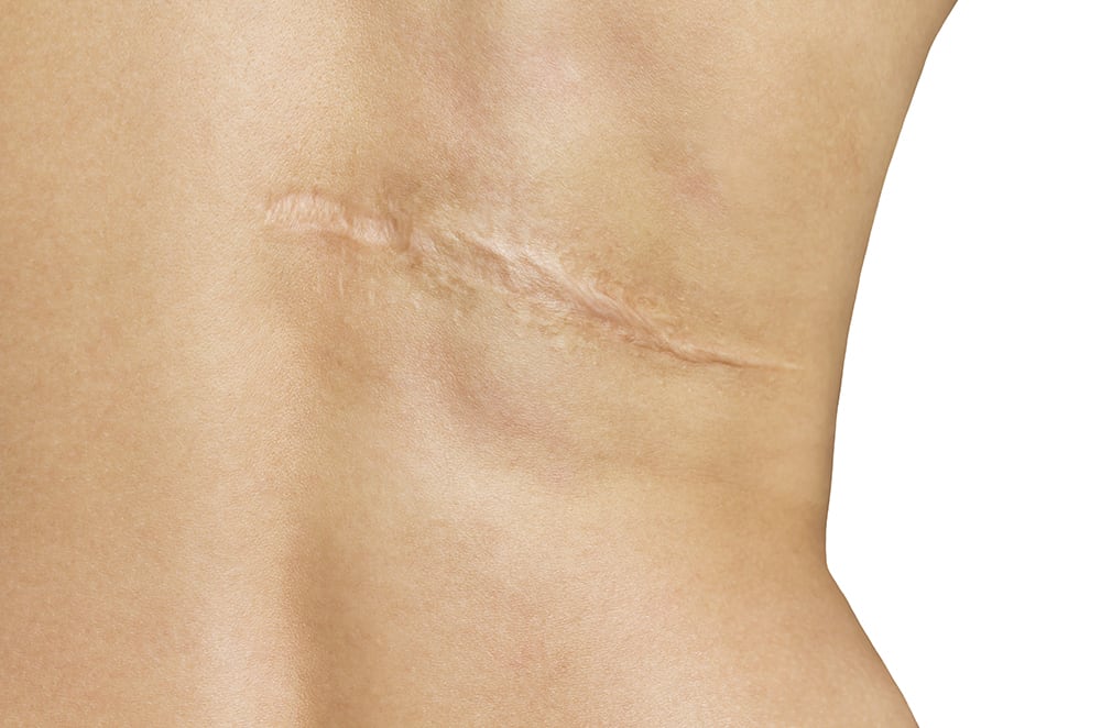 How to Get Rid of Scars for Good