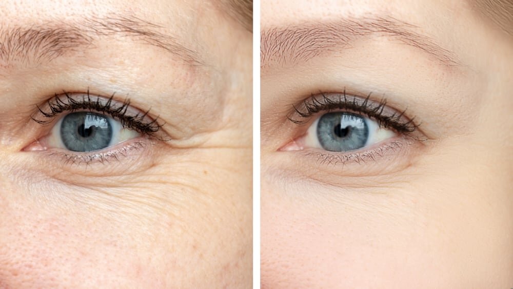 Does botox for crows feet look natural by siti med spa