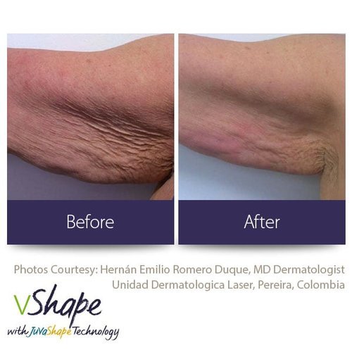 Juvashape-before-and-after-cellulite-san-diego-siti-med-spa.jpeg