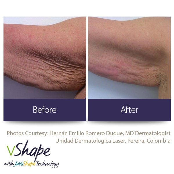Juvashape-before-and-after-cellulite-san-diego-siti-med-spa.jpeg