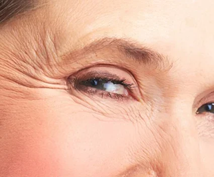 A brown-eyed woman looks closely at wrinkles called "Crows Feet" near her eyes and temple.