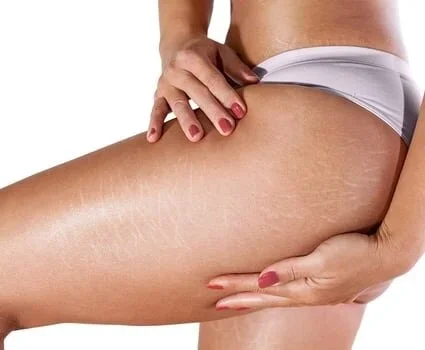 A woman shows mild cellulite on her left leg.