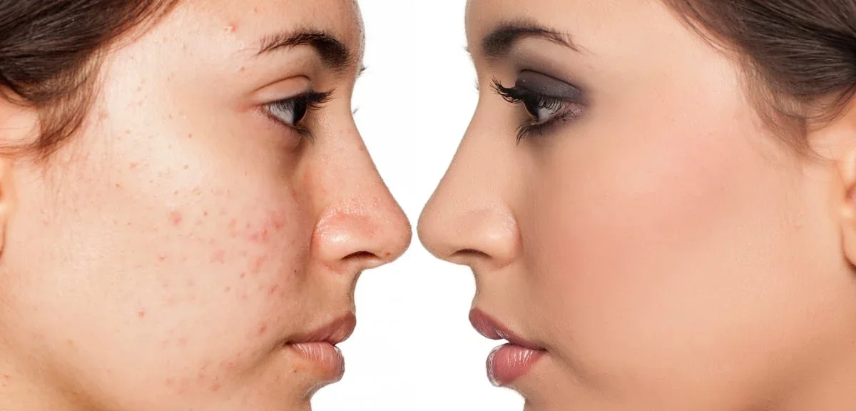 Two girls stare at each other, one with acne, and one with smooth skin.