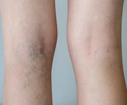 Photo shows examples of various types of veins in the legs.