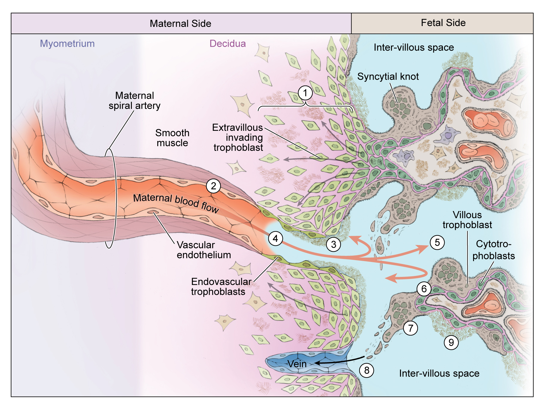 Fetal maternal interaction in severe Preeclampsia