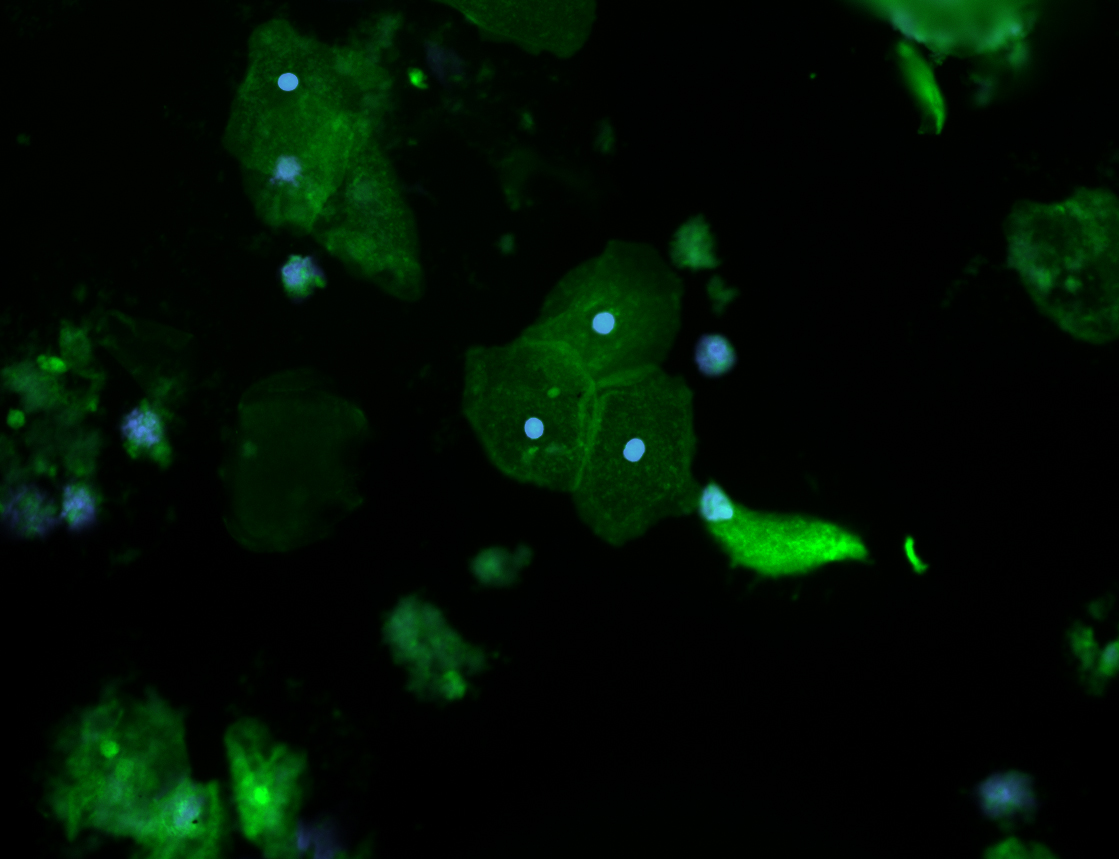 Placental Fetal cells isolated safely using the TRIC procedure were stained for beta-hCG (green) a trophoblast cell marker and nuclei were labeled using DAPI dye.