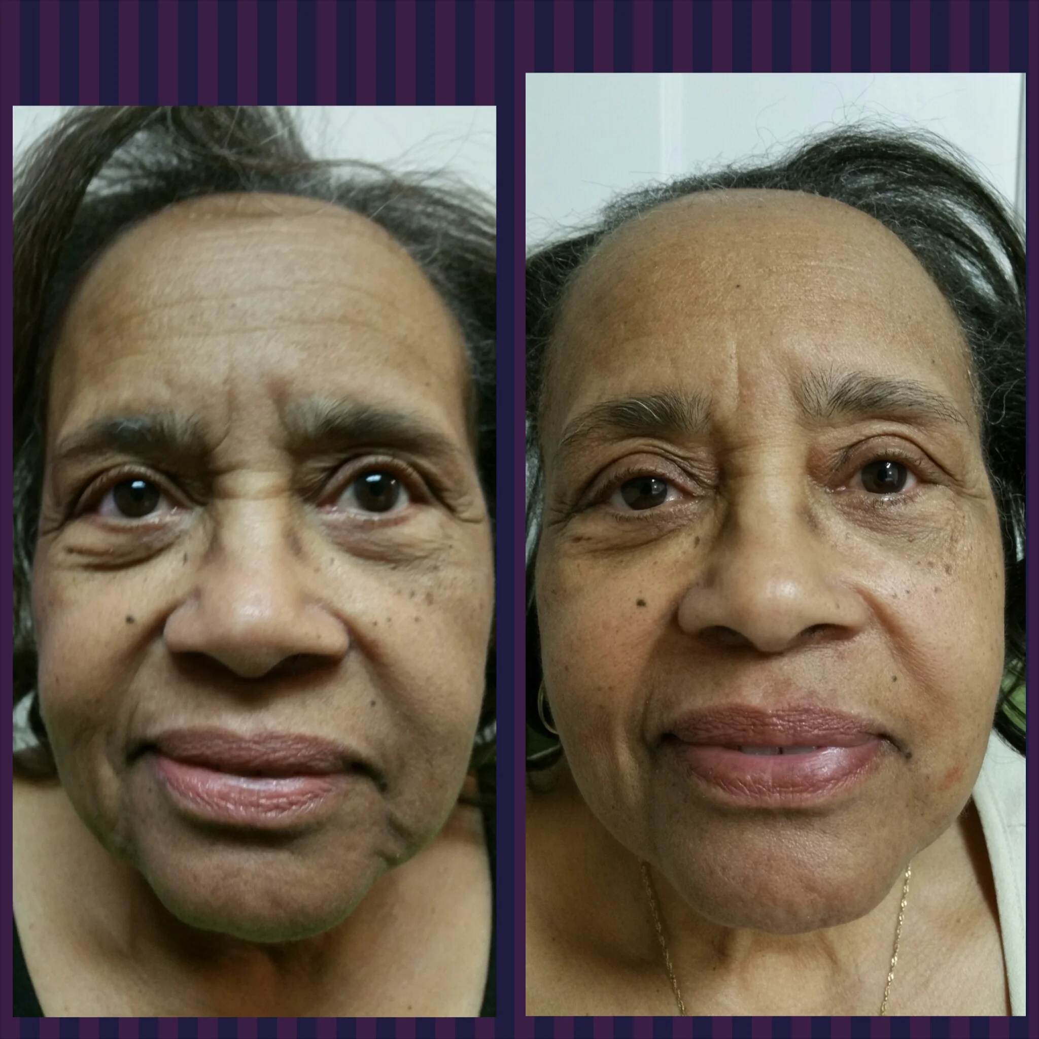 Left is before and Right is after-note the improvement in wrinkles of the forehead, bridge of nose, under eyes, nose to lip groove, and jawline. Results after complete series.