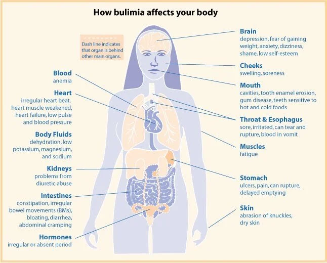 Common Bulimia Medical Complications — BALANCE eating disorder