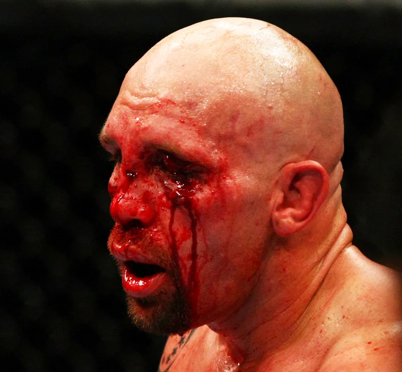 UFC Fight Night 75: Skadelisten