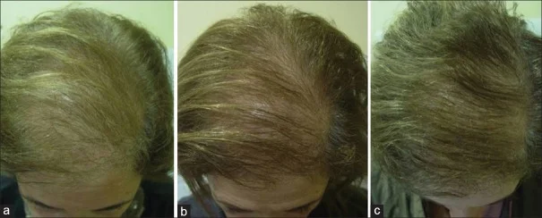 (a) A 51-year-old female with female androgenetic alopecia Ebling III, (b) excellent improvement at 3 months using PRP and (c) further improvement after 6 months, with a decrease of one grade in Ebling's scale (Ebling II). See more pictures. 