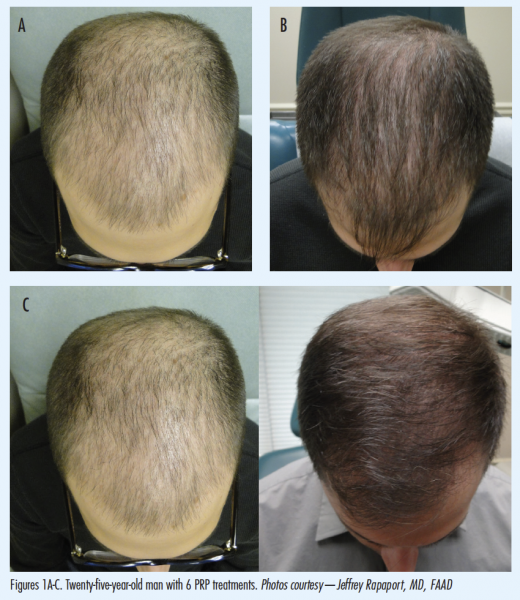 malepatternbaldness.png