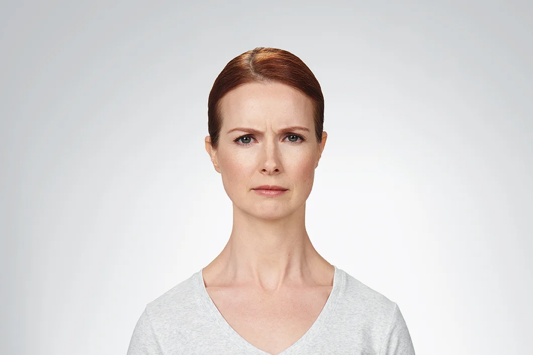 Before Botox between the eyes