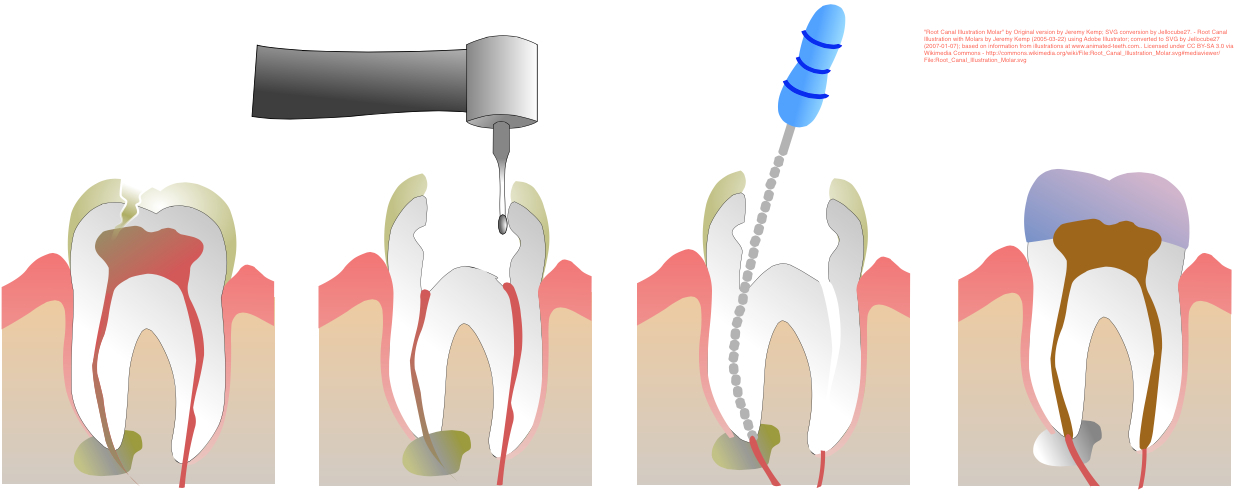 Northbridge Dentists - Root canal