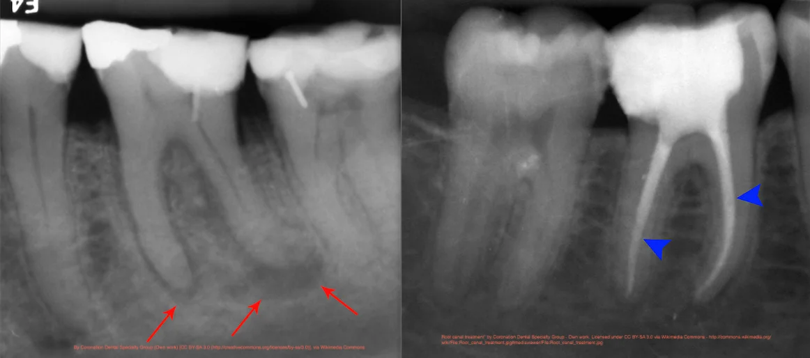 Root Canal Filling X Ray : Assessing root canal fillings on a ...