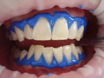 invisalign aspendale