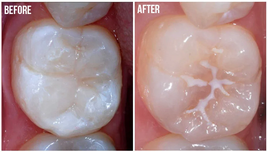 PIT-AND-FISSURE-SEALANTS.jpg