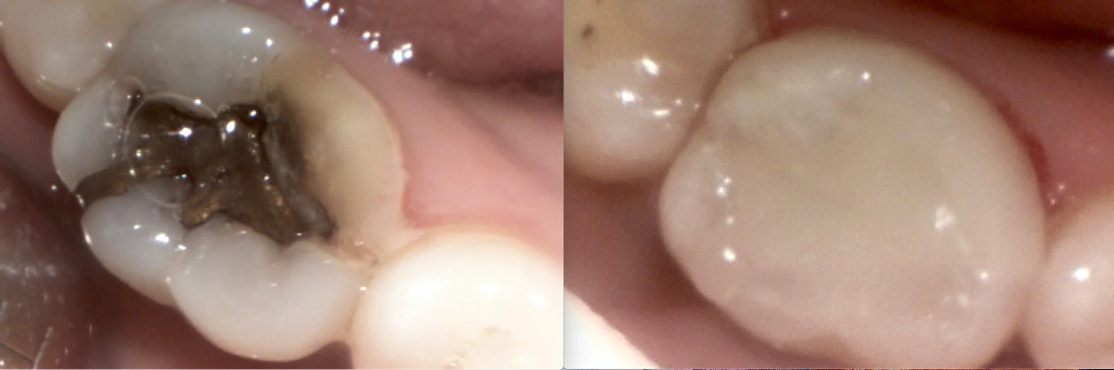 Can you believe these are the SAME TOOTH?! Wonderful results