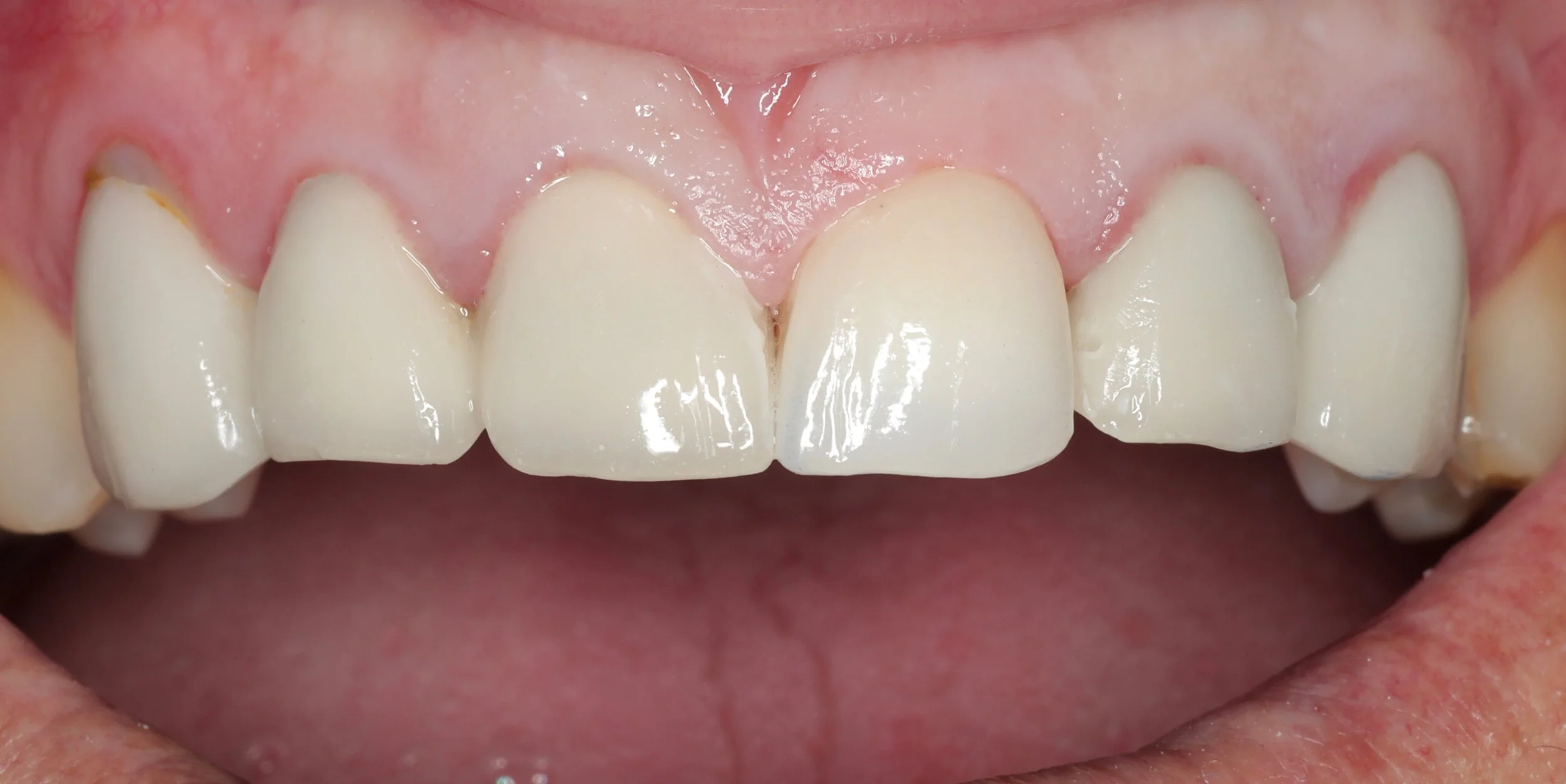 Dental crowns vs Veneers