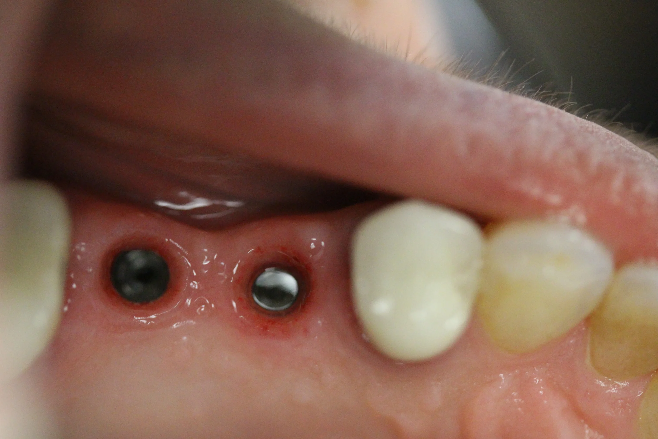 Top view of the two implants.