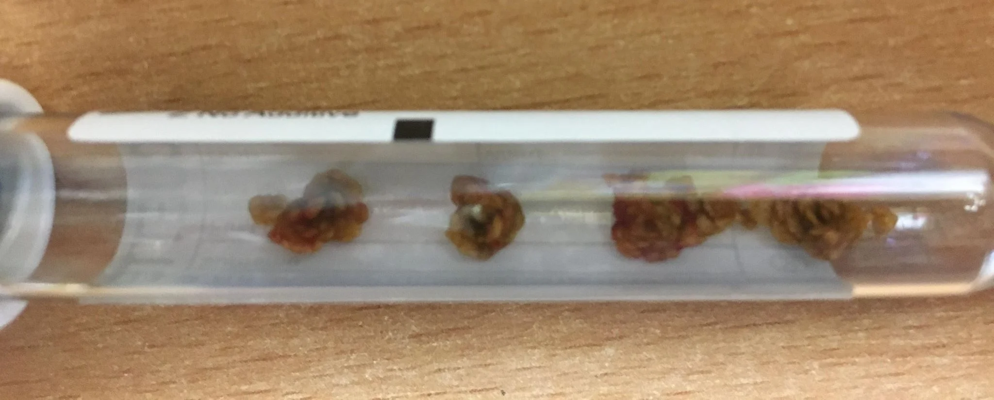 URINARY STONES