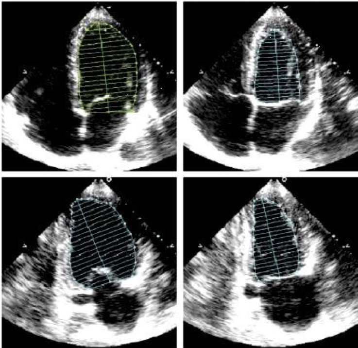 Calculating LV ejection fraction requires tracing the endocardial borders at diastole and systole. Ref: Ciampi and Villari, Cardiovascular Ultrasound 2007; 5:34.