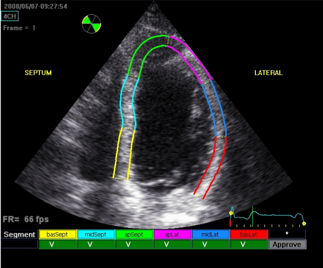 Speckle tracking is used to measure myocardial strain. This is now routinely performed.