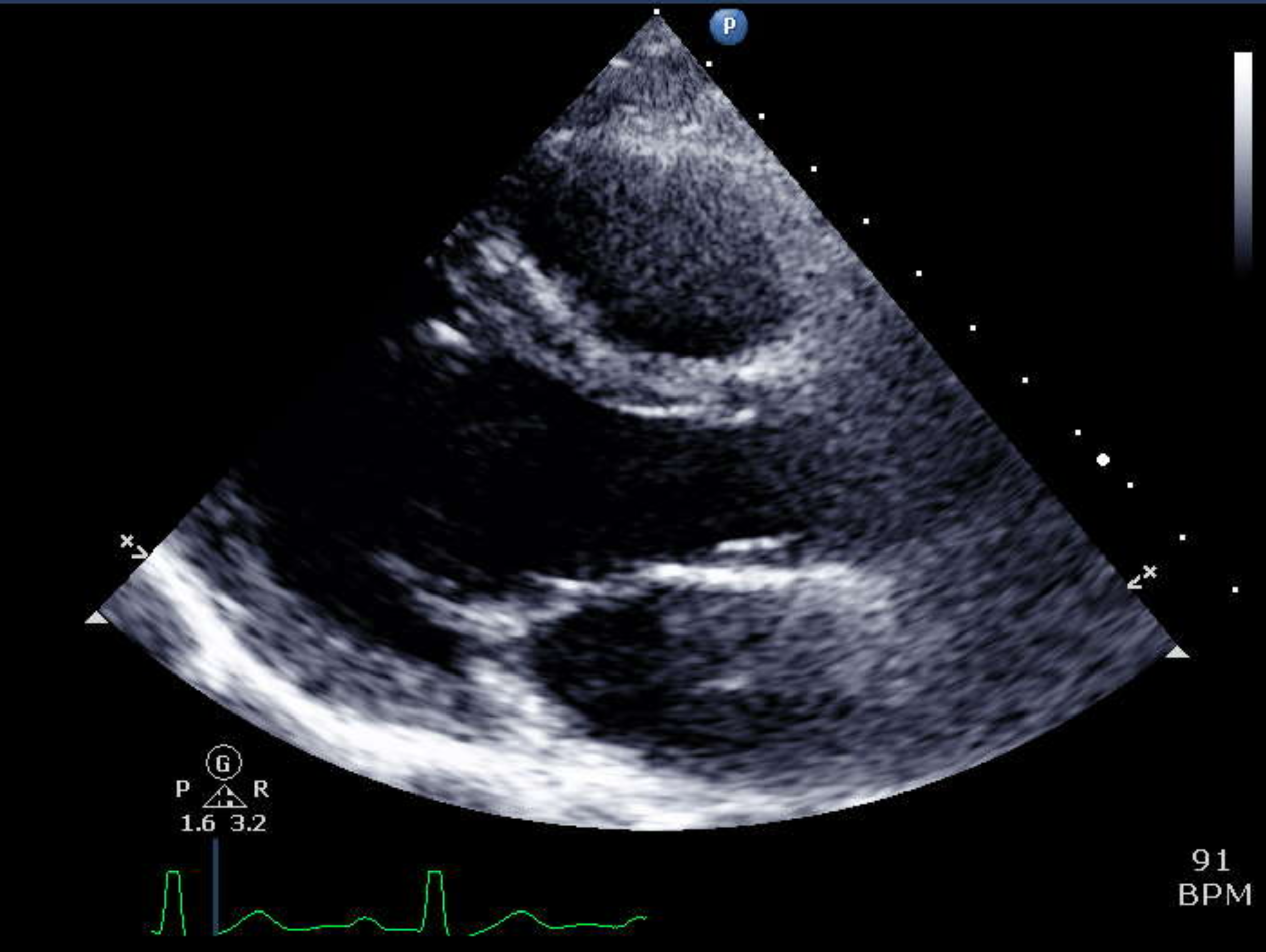 Global longitudinal strain: A new gold standard for assessing