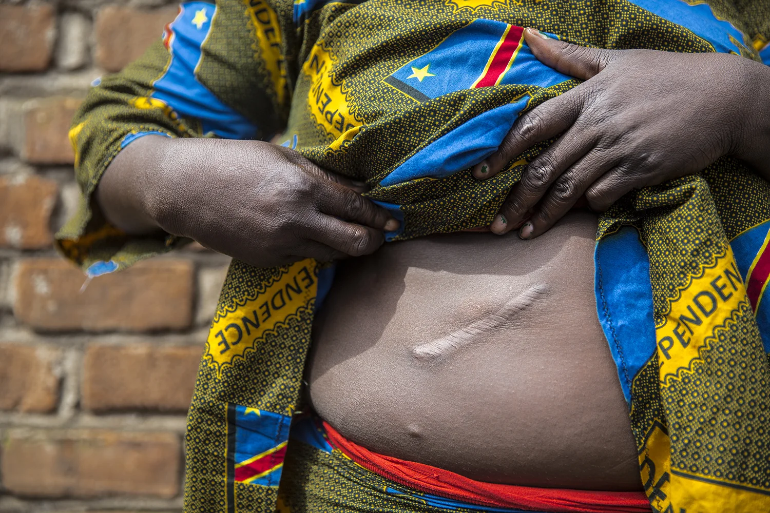Suzanna: “One time when he was drunk, he stabbed me damaging my liver after which I needed surgery.”