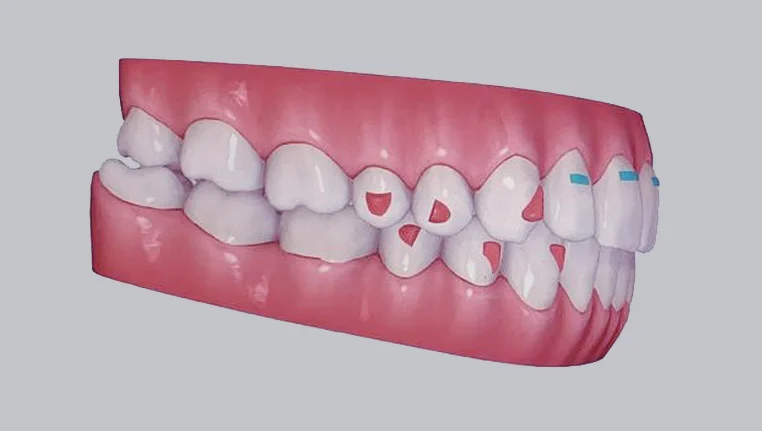 TEETH-AFTER.jpg