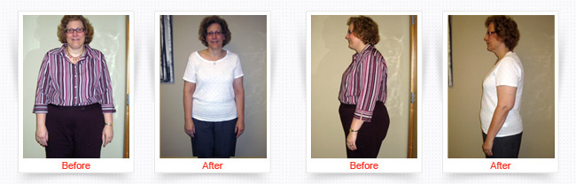 Weight Loss Progress Photos Before And After Front and Side View Of Female Patient Wearing Pink and White Shirt