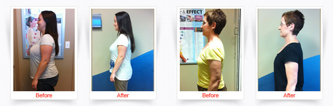 ChiroThin Weight Loss Progress Photos Front and Side Before And After Of Older Female Patient Wearing White Shirt