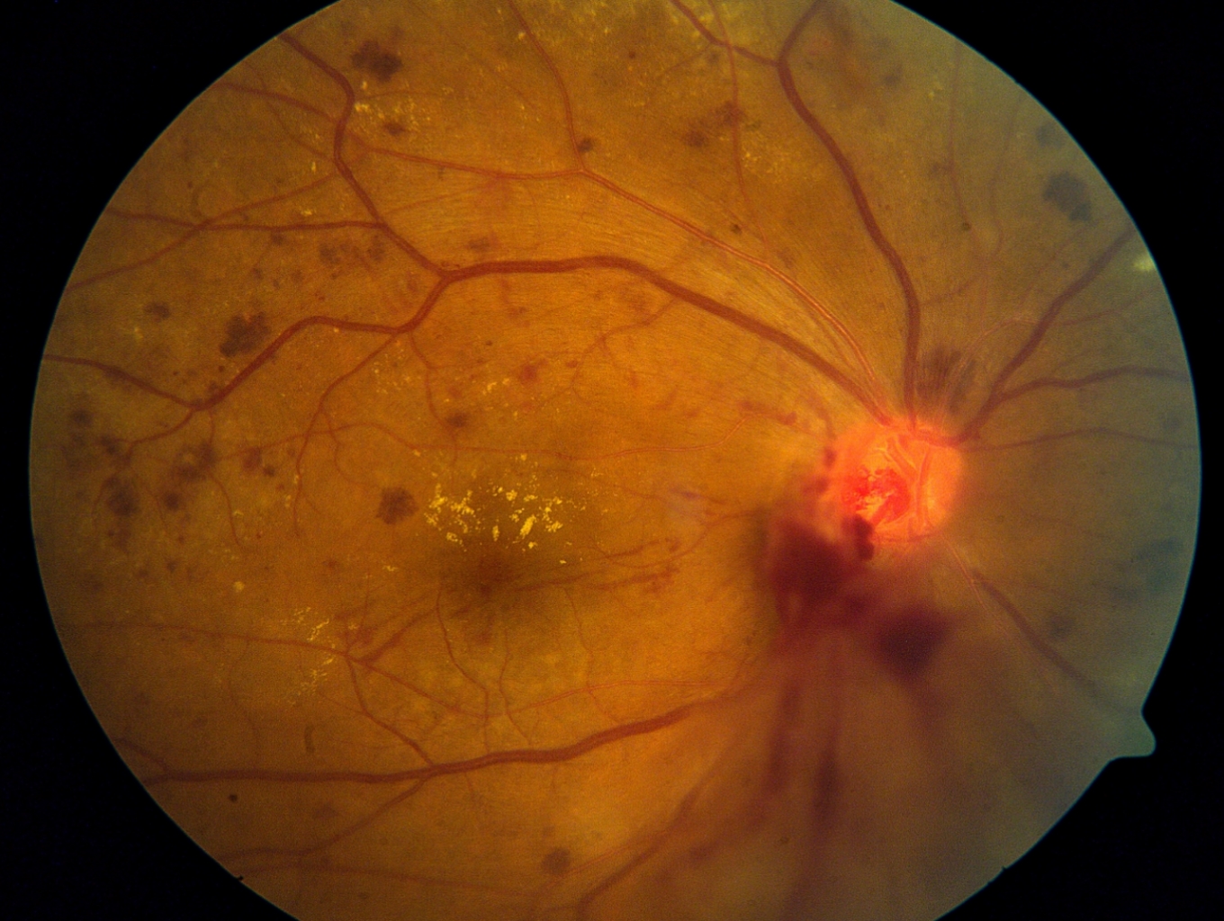 DIABETIC RETINOPATHY