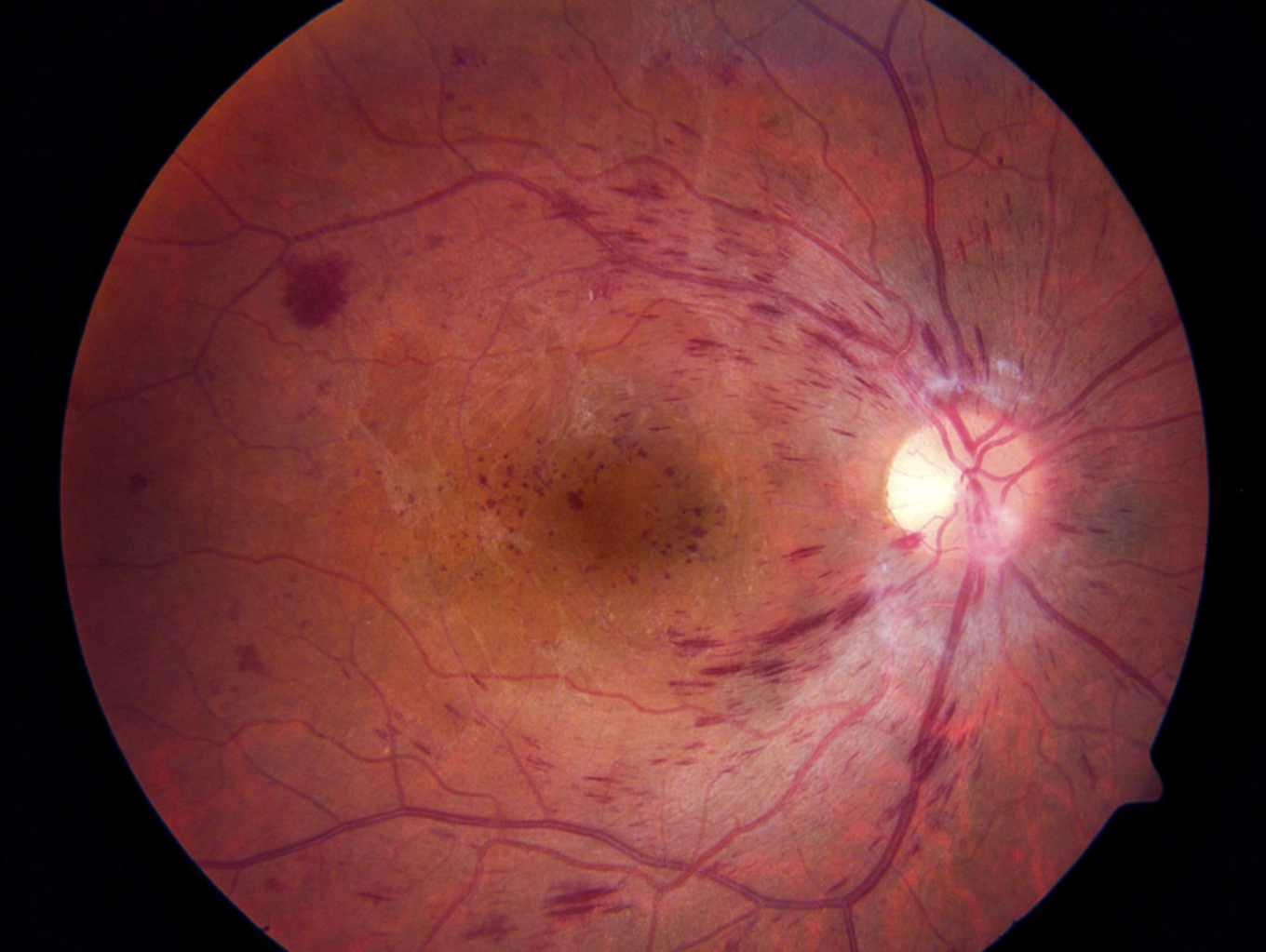 RETINAL VEIN OCCLUSION