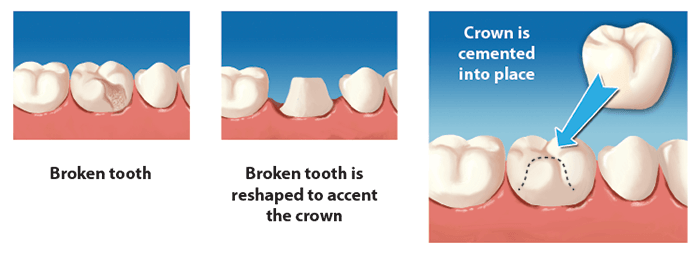 dental-crown.png