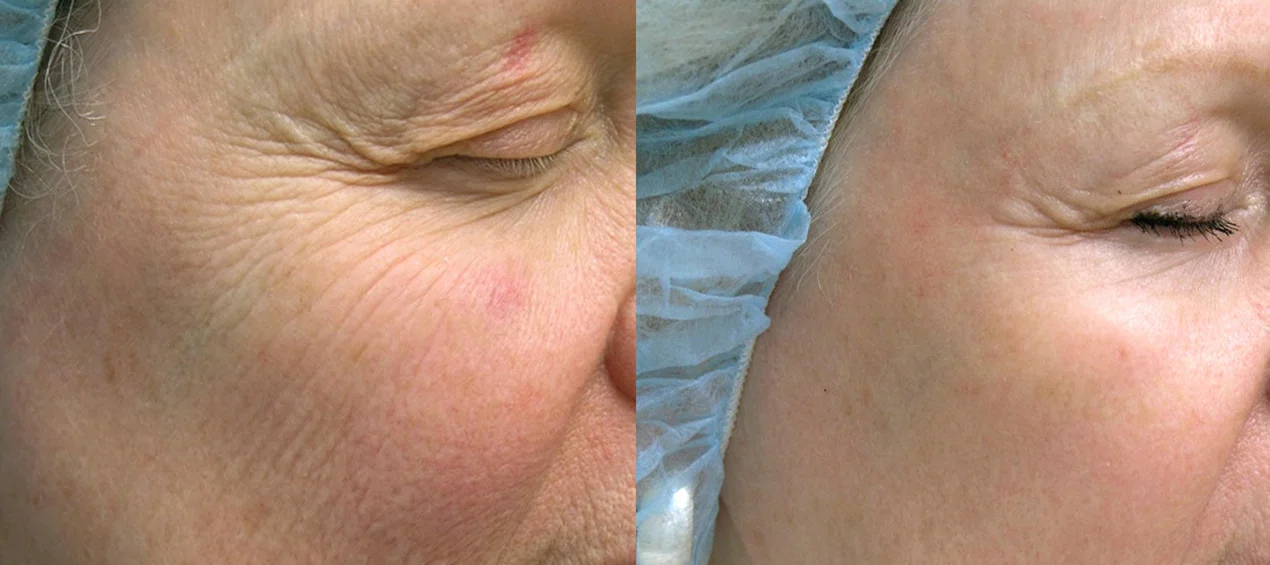 Icon-2940-D-Kent-wrinkle-prepost1Tx.jpg