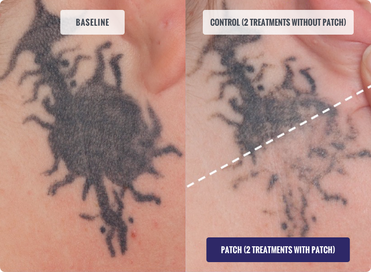 Tattoo Removal Just Became A Little Easier - A Letter From Tyffanie