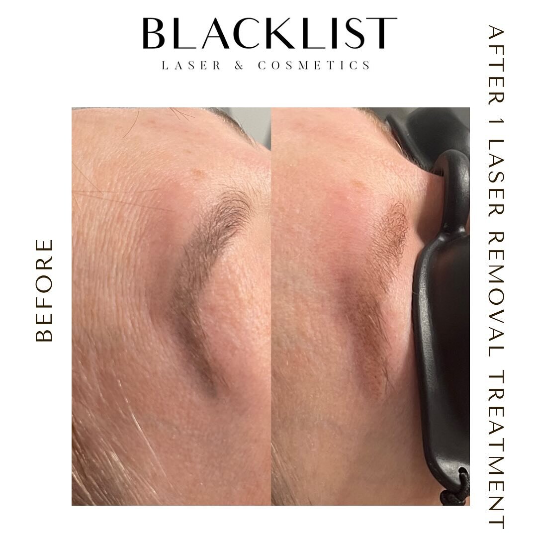 Look at these results on this PMU brows after just one session of laser tattoo removal! Old brows are gone and all her hair is still there. We love to see it! Use our website to book your free consultation!🖤⚡️