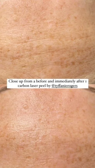 Carbon Laser Peels aka The Hollywood Facial.. Is this the right facial for you?